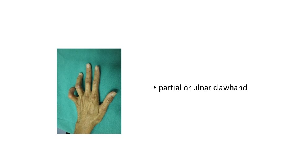  • partial or ulnar clawhand 