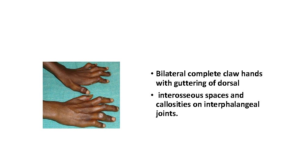  • Bilateral complete claw hands with guttering of dorsal • interosseous spaces and