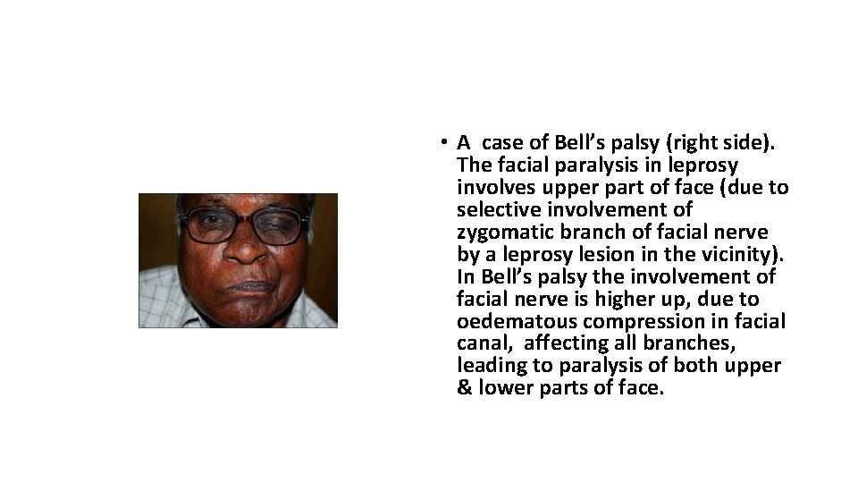  • A case of Bell’s palsy (right side). The facial paralysis in leprosy