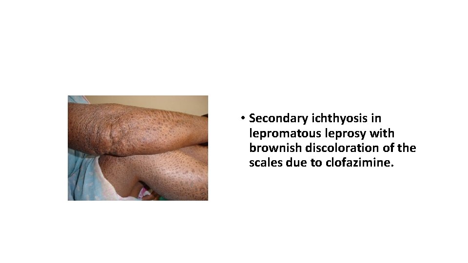  • Secondary ichthyosis in lepromatous leprosy with brownish discoloration of the scales due
