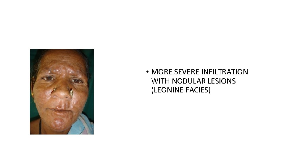  • MORE SEVERE INFILTRATION WITH NODULAR LESIONS (LEONINE FACIES) 