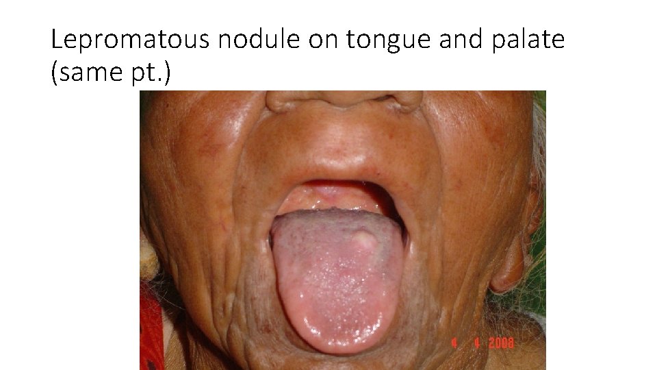 Lepromatous nodule on tongue and palate (same pt. ) 