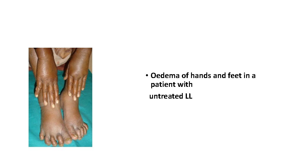  • Oedema of hands and feet in a patient with untreated LL 