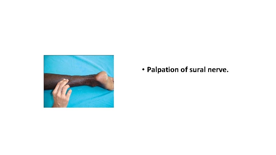 • Palpation of sural nerve. 