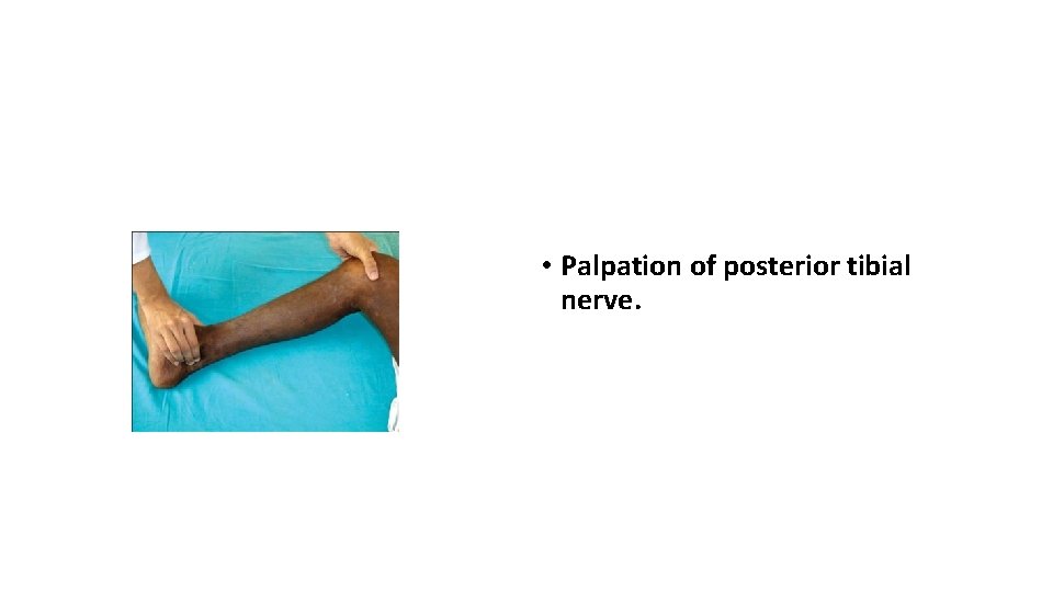  • Palpation of posterior tibial nerve. 