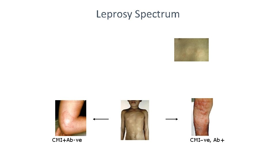 Leprosy Spectrum CMI+Ab-ve CMI–ve, Ab+ 