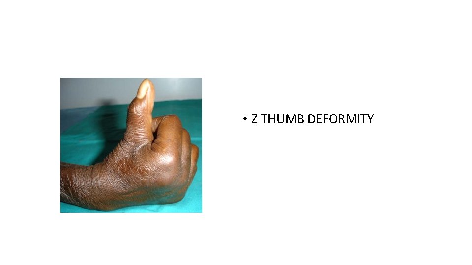  • Z THUMB DEFORMITY 