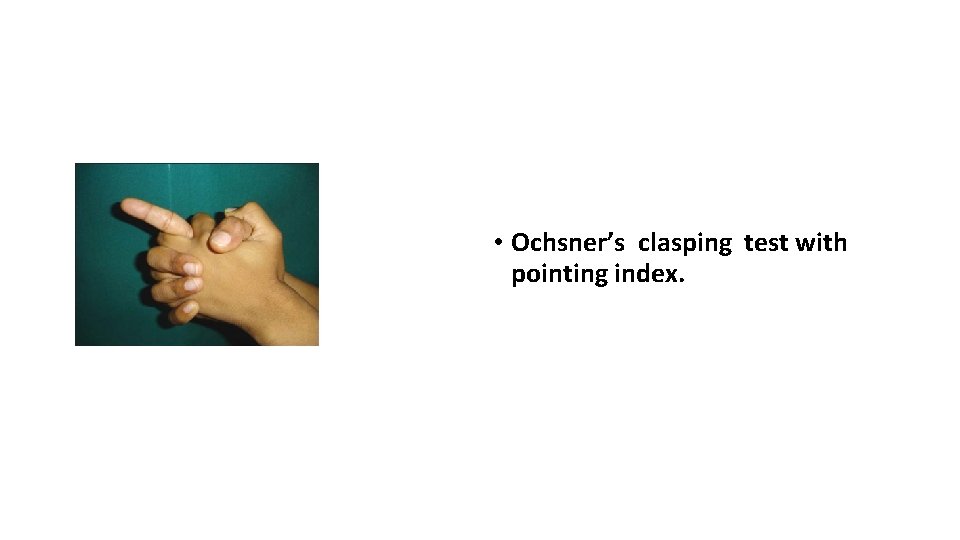  • Ochsner’s clasping test with pointing index. 