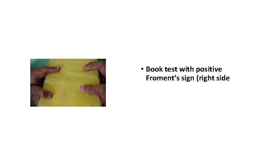  • Book test with positive Froment’s sign (right side 