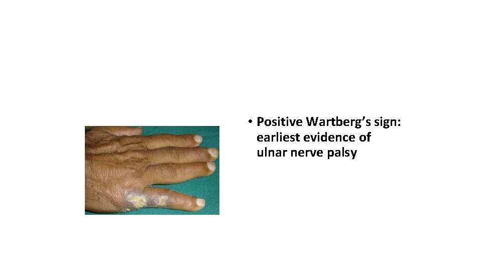  • Positive Wartberg’s sign: earliest evidence of ulnar nerve palsy 