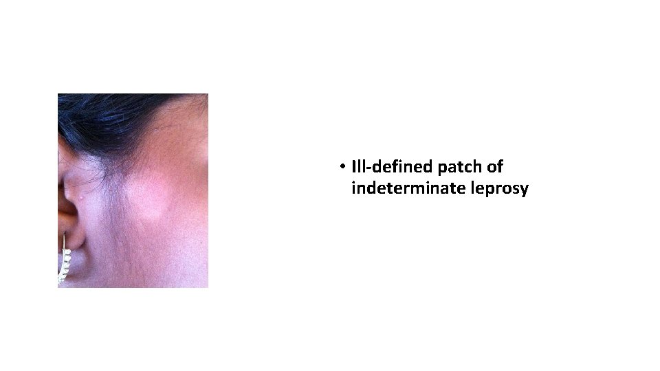  • Ill-defined patch of indeterminate leprosy 
