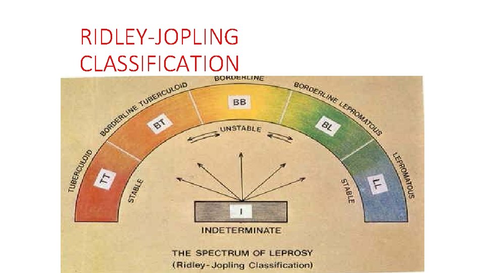 RIDLEY-JOPLING CLASSIFICATION 