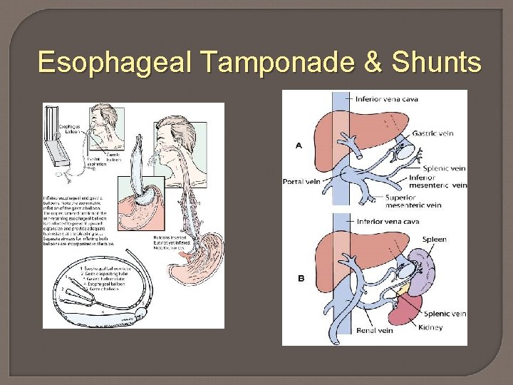 Esophageal Tamponade & Shunts 