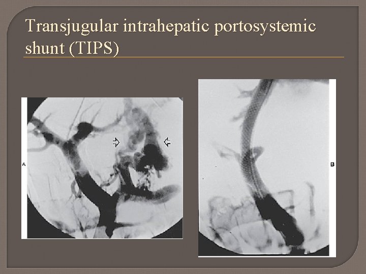 Transjugular intrahepatic portosystemic shunt (TIPS) 