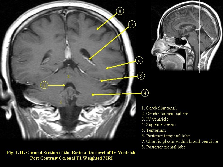 8 7 6 3 5 2 4 1 1. Cerebellar tonsil 2. Cerebellar hemisphere