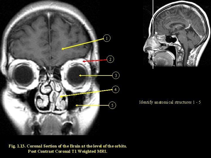 1 2 3 4 5 Fig. 1. 13. Coronal Section of the Brain at