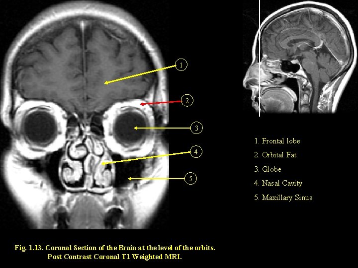 1 2 3 1. Frontal lobe 4 2. Orbital Fat 3. Globe 5 4.
