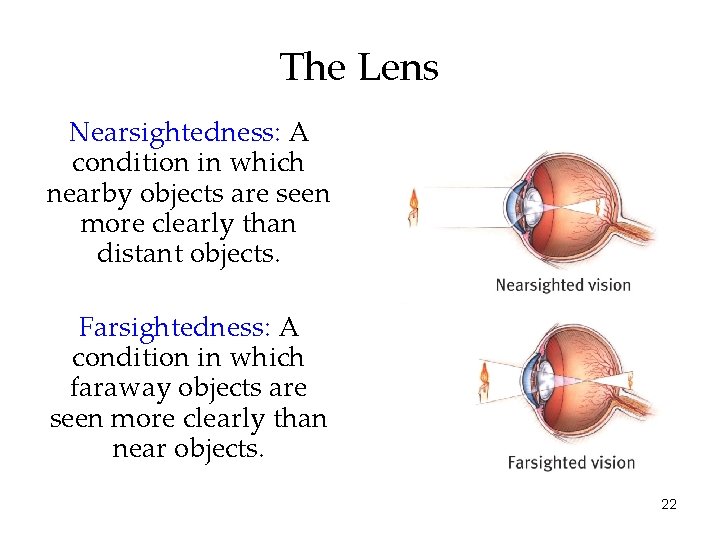 The Lens Nearsightedness: A condition in which nearby objects are seen more clearly than