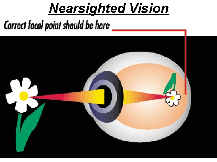 Nearsighted Vision 24 