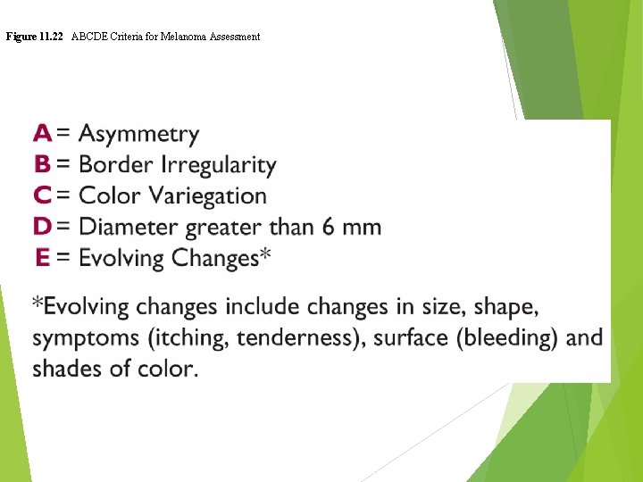 Figure 11. 22 ABCDE Criteria for Melanoma Assessment 