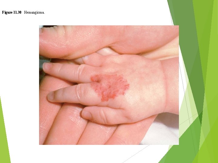 Figure 11. 30 Hemangioma. 