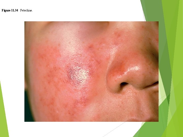 Figure 11. 34 Petechiae. 