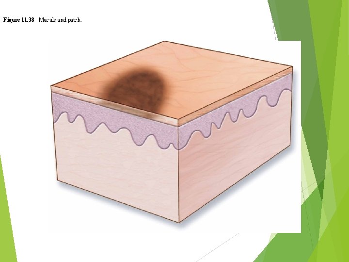 Figure 11. 38 Macule and patch. 