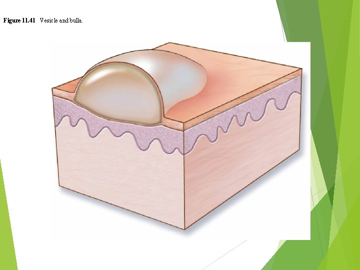 Figure 11. 41 Vesicle and bulla. 