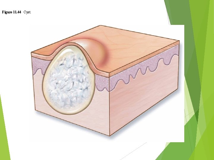 Figure 11. 44 Cyst. 