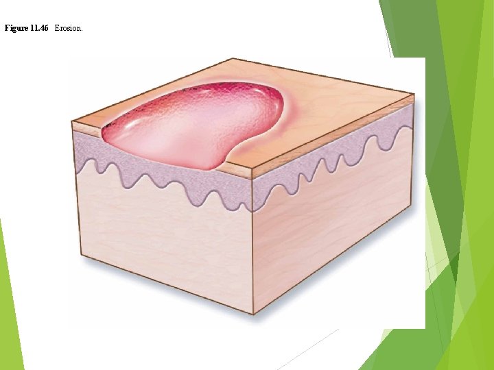 Figure 11. 46 Erosion. 