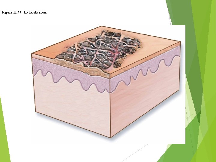 Figure 11. 47 Lichenification. 