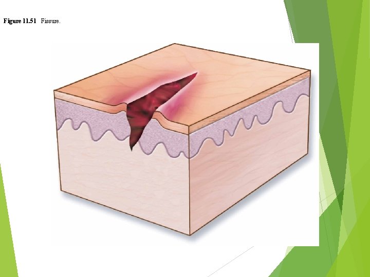 Figure 11. 51 Fissure. 