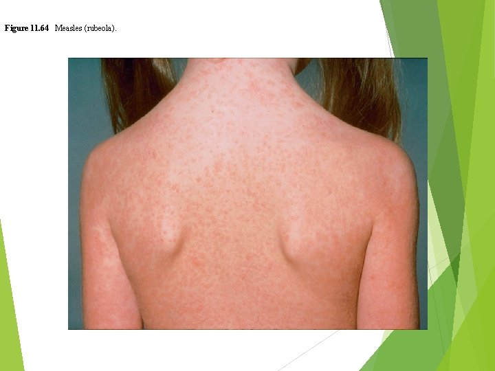 Figure 11. 64 Measles (rubeola). 