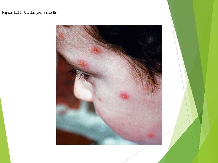 Figure 11. 66 Chickenpox (varicella). 