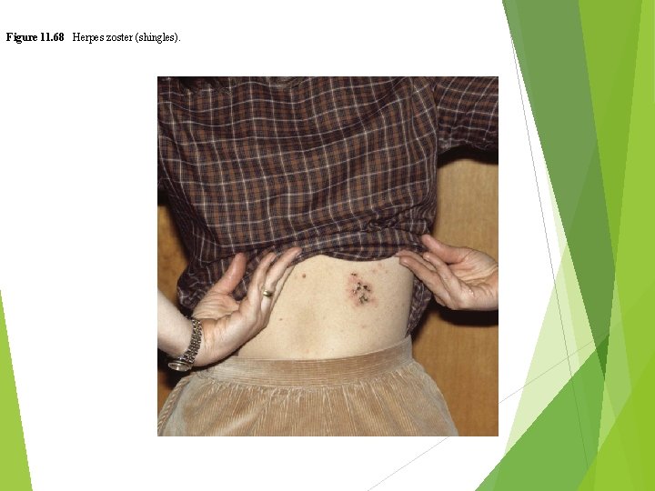 Figure 11. 68 Herpes zoster (shingles). 