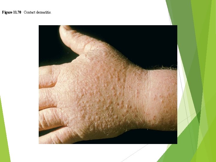 Figure 11. 70 Contact dermatitis. 