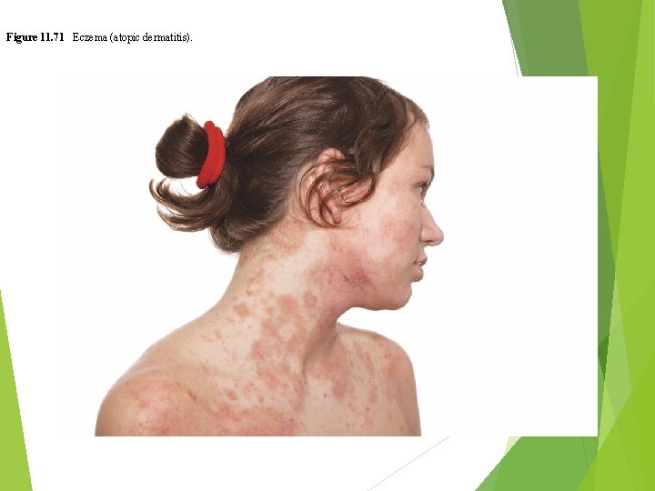 Figure 11. 71 Eczema (atopic dermatitis). 