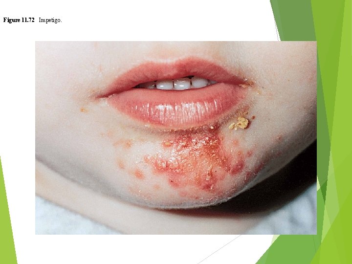 Figure 11. 72 Impetigo. 