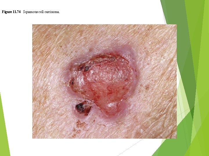 Figure 11. 74 Squamous cell carcinoma. 
