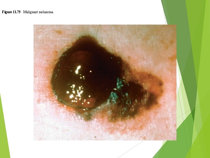 Figure 11. 75 Malignant melanoma. 