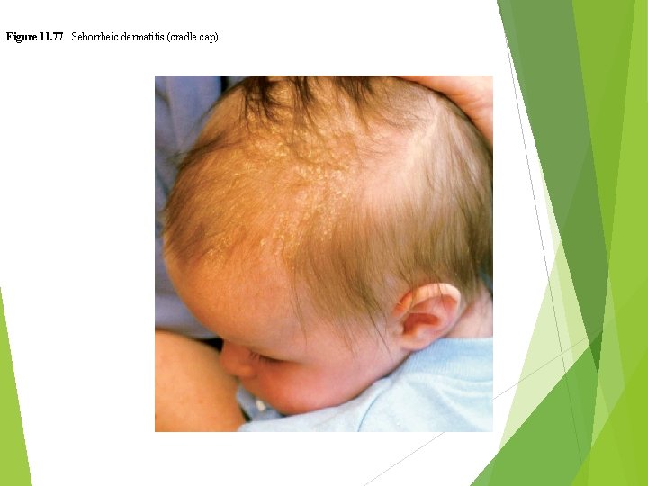 Figure 11. 77 Seborrheic dermatitis (cradle cap). 