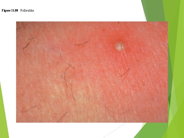 Figure 11. 80 Folliculitis. 