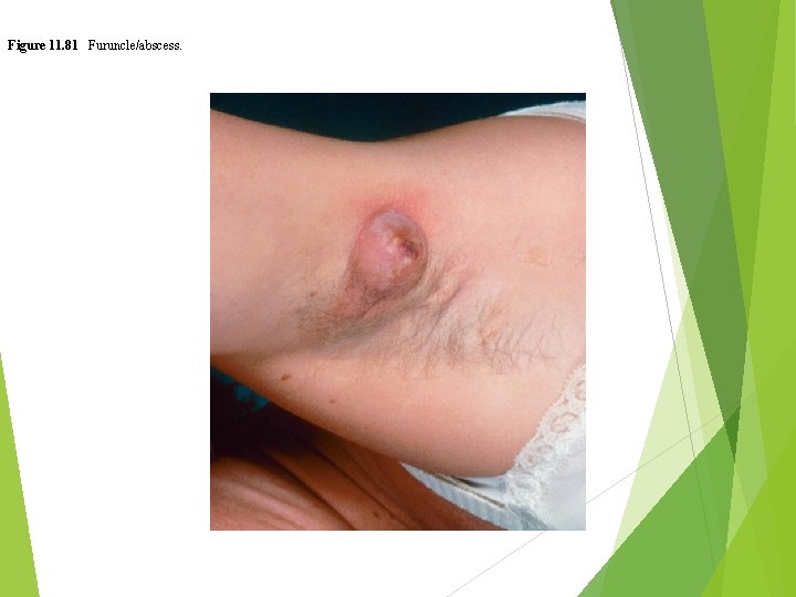 Figure 11. 81 Furuncle/abscess. 