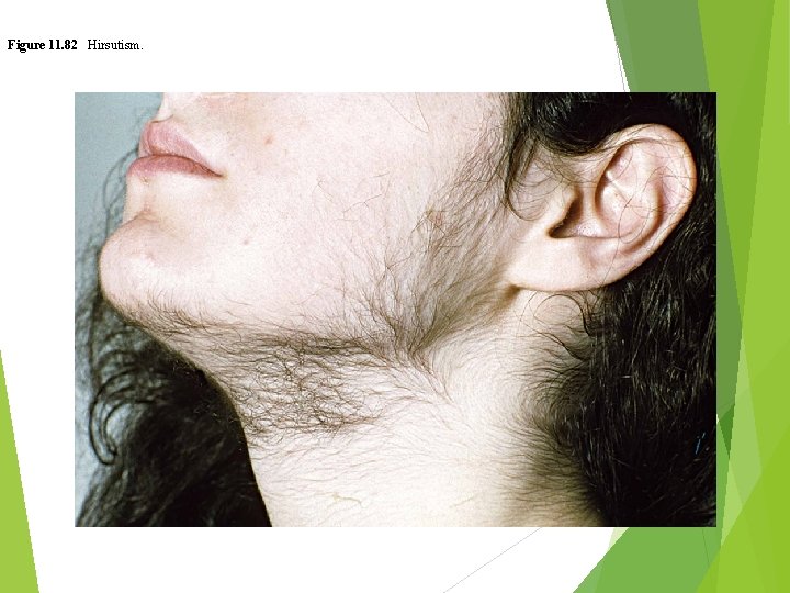 Figure 11. 82 Hirsutism. 