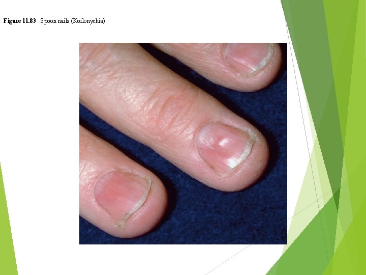 Figure 11. 83 Spoon nails (Koilonychia). 