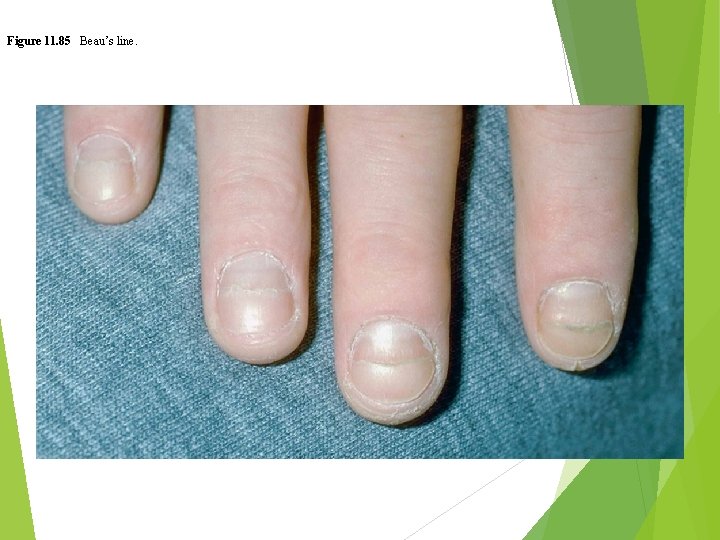 Figure 11. 85 Beau’s line. 
