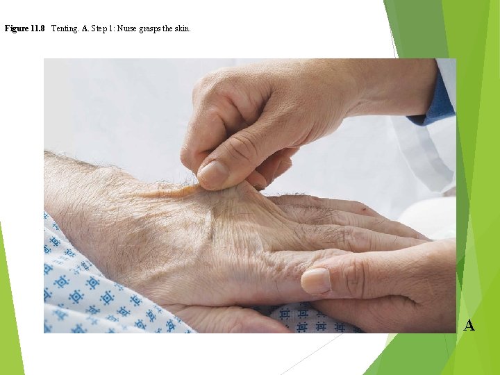 Figure 11. 8 Tenting. A. Step 1: Nurse grasps the skin. A 