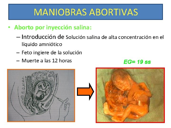 MANIOBRAS ABORTIVAS • Aborto por inyección salina: – Introducción de Solución salina de alta