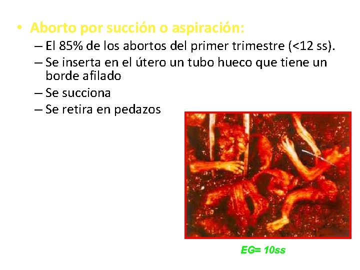  • Aborto por succión o aspiración: – El 85% de los abortos del