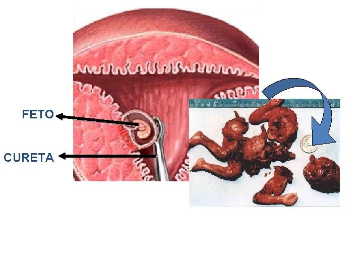 FETO CURETA 